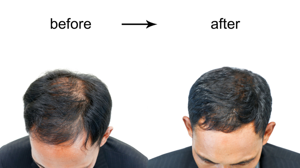 Hair growth serum for men|yourleaf.in|Biotin Hair Growth Serum by Pureauty Naturals before after result